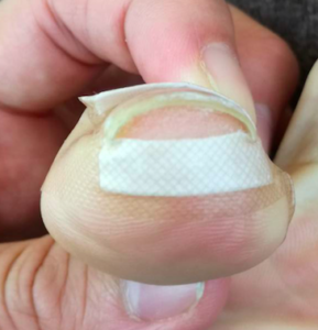 簡単 痛い巻き爪の応急処置 名古屋の巻き爪フットケア専門院 特許取得済みの痛くない巻き爪施術